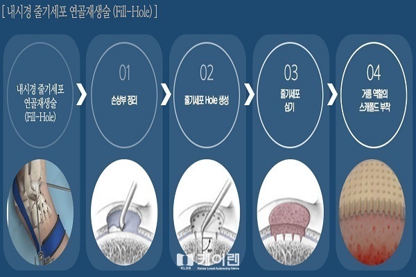 [칼럼] 손상된 발목의 연골, 해법으로 등장한 줄기세포